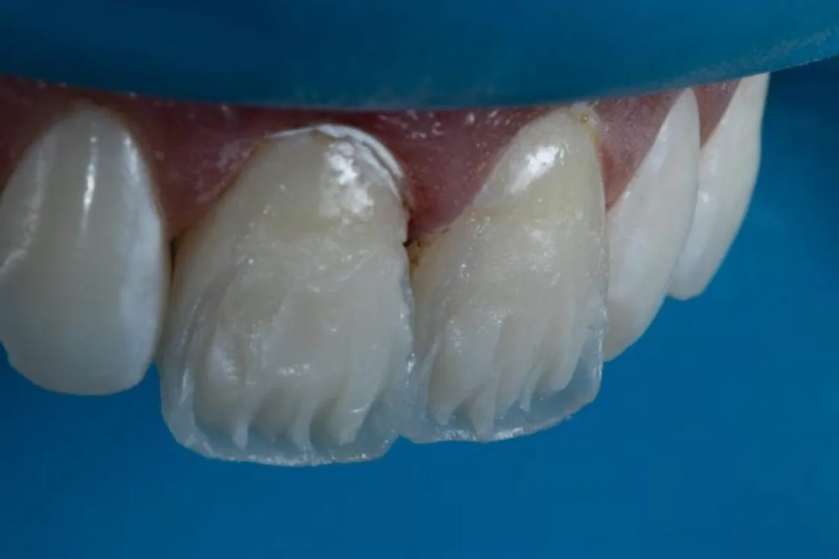 Estratificação interna com resinas para dentina