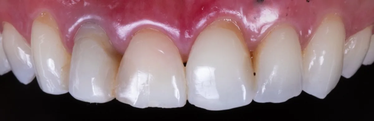 Situação inicial com dentes fraturados e resinas malfeitas