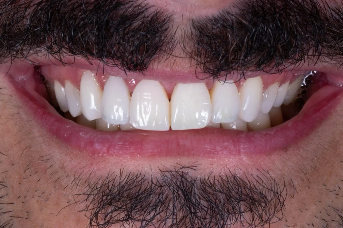 Resultado imediato após facetas de resina