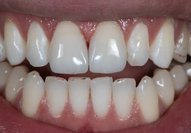 Caso 2 depois: sorriso do paciente após as facetas de resina